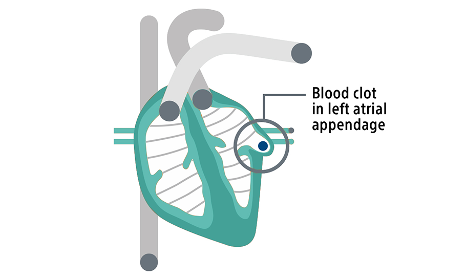 Graphic of a heart showing a blood cloth in the left atrial appendage.